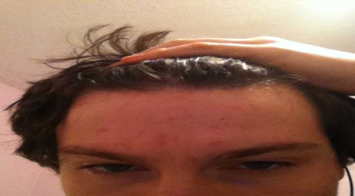 Super remedios caseros contra el acné